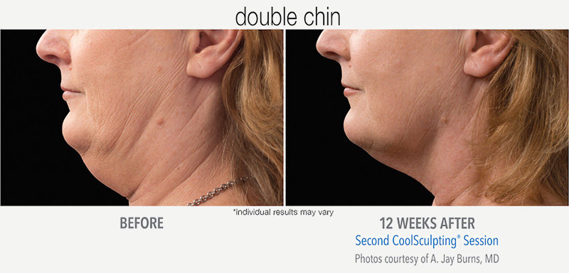 CoolSculpting Before and After Chin CoolMini