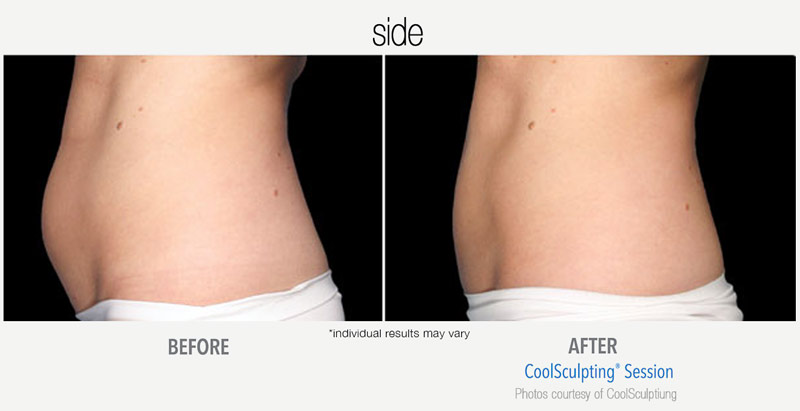 CoolSculpting Before and After Side