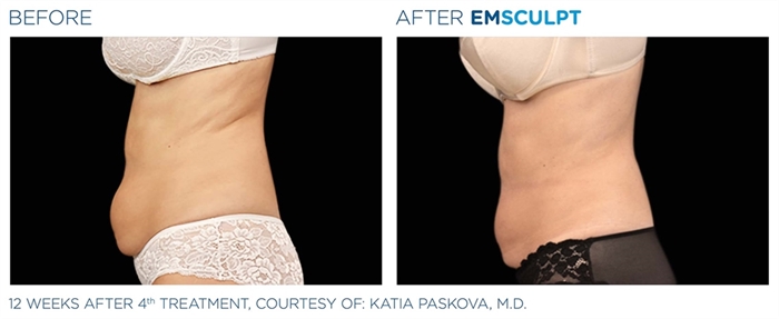 Image related to Emsculpt for Body Contouring