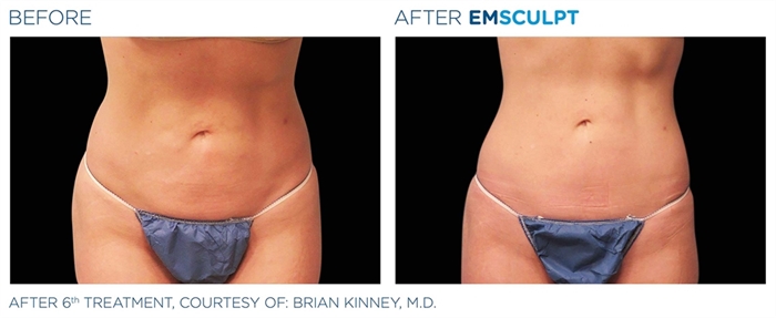 Image related to Emsculpt for Body Contouring
