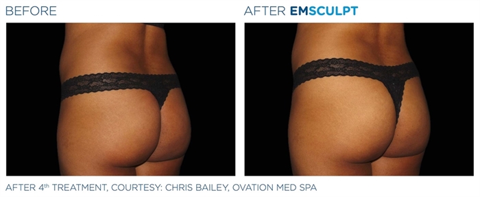 Image related to Emsculpt for Body Contouring