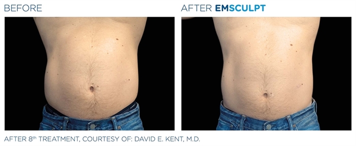 Image related to Emsculpt for Body Contouring