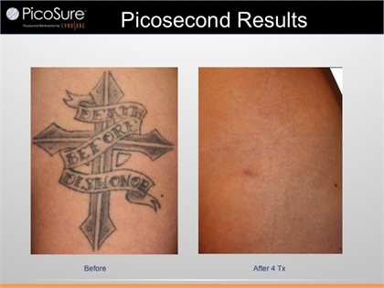 Laser Tattoo Removal  Skin Revitalization