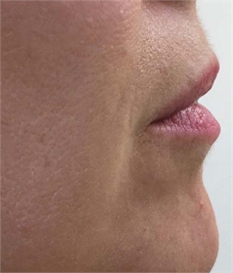 Juvederm Volbella Before and After Greenwich, CT